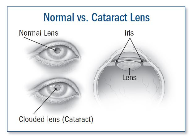 Cataract