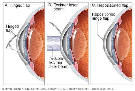 Lasik